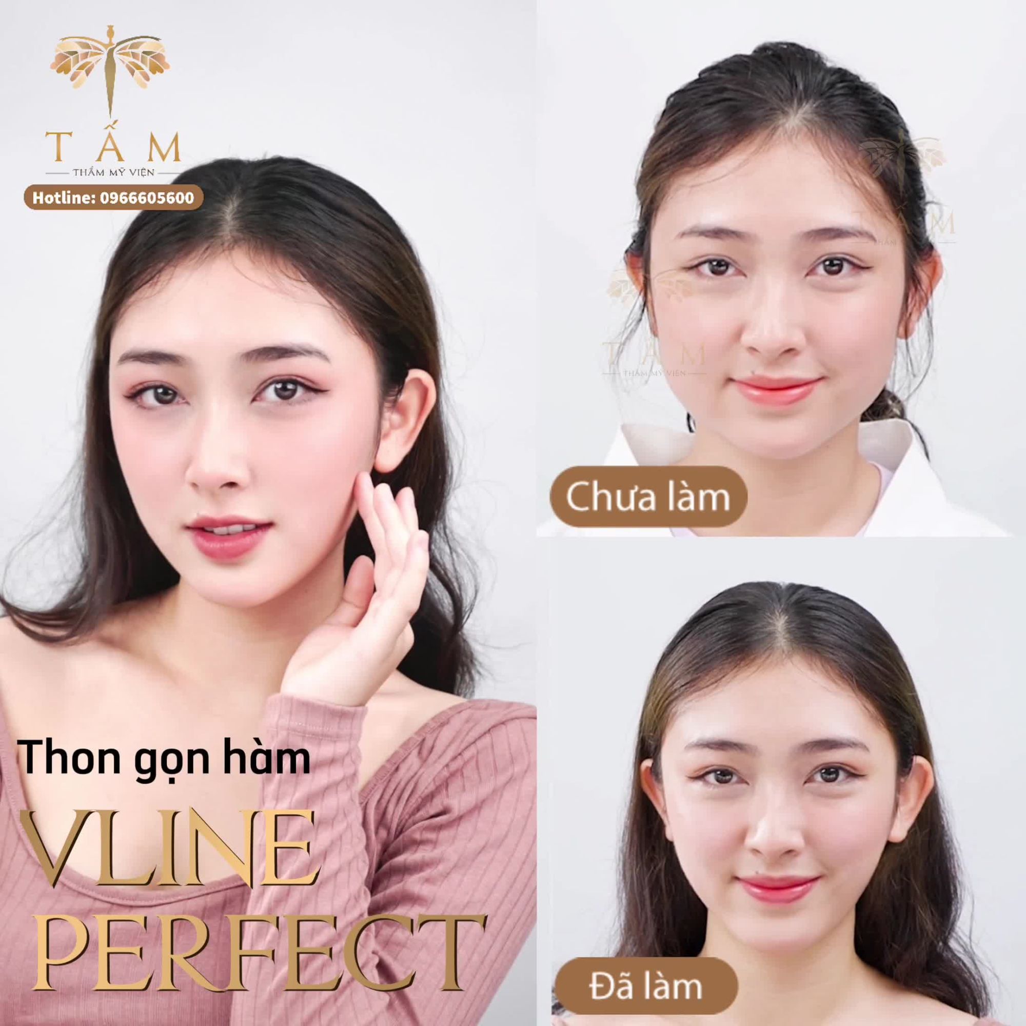 GƯƠNG MẶT SIÊU THON GỌN CHỈ VỚI 1 LẦN THỰC HIỆN: THON GỌN HÀM VLINE PERFECT